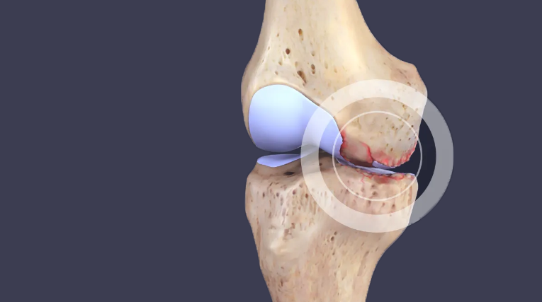 Fiziopatologia osteoartritei