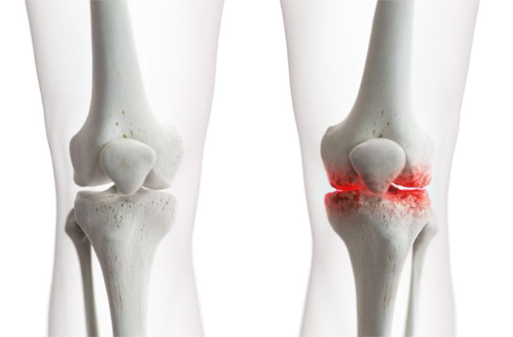 Cauze ale aparitiei osteoartritei