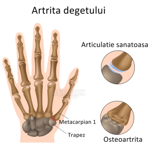 Dureri articulare la degetele mâinilor