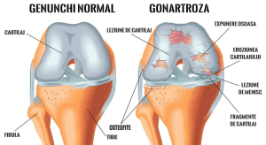 Artrita Genunchiului